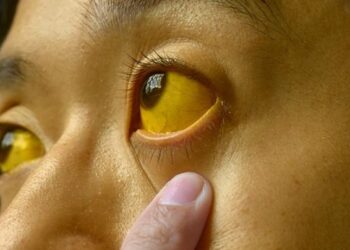 Jaundice in Qazigund: Situation under control, no need to panic: BMO