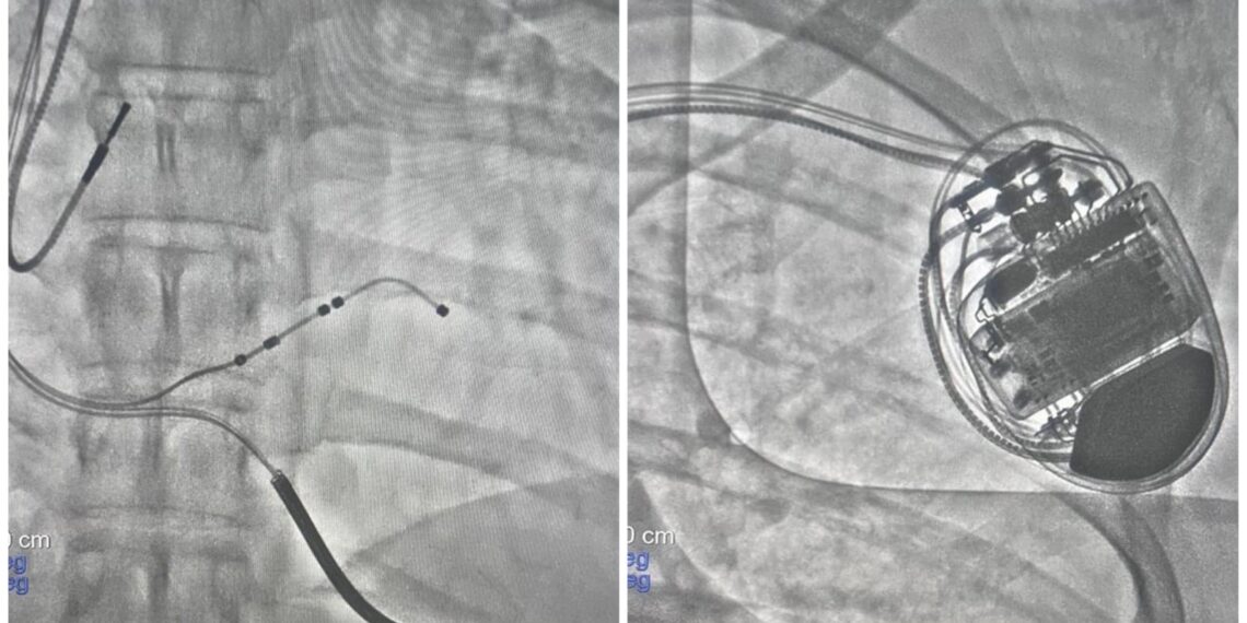 Paras Health Srinagar Saves Brazilian Patient in Rare, Life-Saving CRT-D Heart Procedure