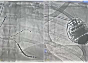 Paras Health Srinagar Saves Brazilian Patient in Rare, Life-Saving CRT-D Heart Procedure